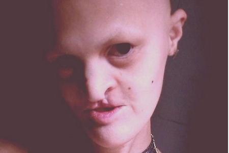 Ein Gendefekt namens ektrodermale Dysplasie ist verantwortlich für die Auffälligkeiten in Melanie Gaydos Gesicht. Obwohl sic...