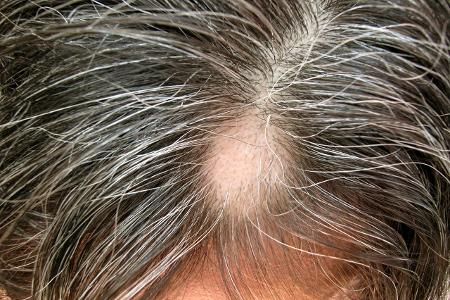 Haarausfall4_imagebroker_Rosseforp.jpg