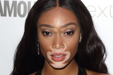 Winnie Harlow wurde durch 