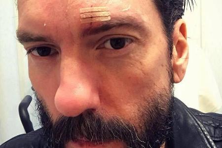 Alec Völkel hat eine mysteriöse Verletzung über seinem Auge