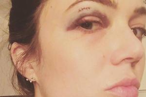 Selfies gehen immer: Mandy Moore zeigt ihr blaues Auge