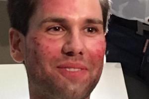 Mit dem sogenannten Vampir-Lifting machte sich Alexander Keen alias "Honey" fit fürs "Dschungelcamp"