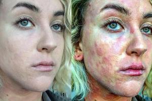 Hinterlässt nicht nur äußerliche Spuren: Die Schuppenflechte bei Ciena Rae Nelson