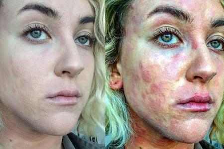 Hinterlässt nicht nur äußerliche Spuren: Die Schuppenflechte bei Ciena Rae Nelson