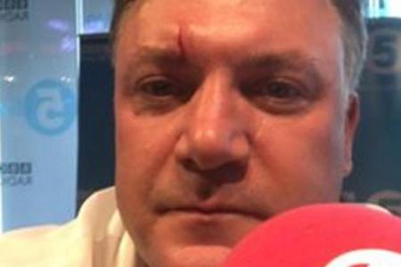 Über dem rechten Auge von Ed Balls ist der Cut gut zu sehen