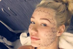 Iggy Azalea beim Schönheitsdoktor