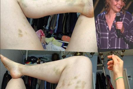 Beth Stellings Beine sind übersät von blauen Flecken