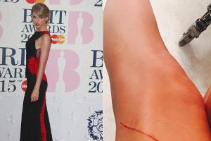 Autsch! Das sieht aber böse aus. Ein roter Kratzer ziert ein Bein von Taylor Swift