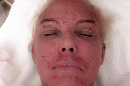 Natascha Ochsenknecht kurz nach einem Gesichts-Lifting