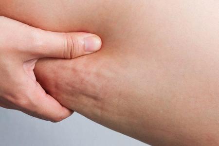 Welche Frau kennt die unbeliebten Dellen an den Oberschenkeln oder dem Hintern nicht? Ein paar Tipps können helfen, Cellulit...