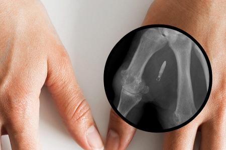 6 Prozent sind der Ansicht, dass Smartphones bis 2030 durch Chips ersetzt werden könnten, die implantiert werden.