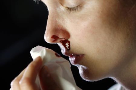 Nasenbluten_Jochen Tack.jpg