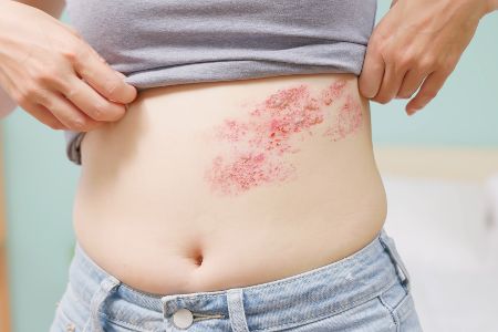 Person mit Gürtelrose