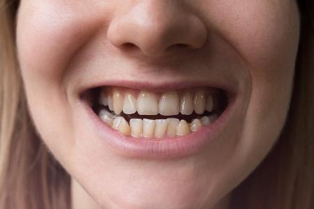 Schiefe Zähne bei Erwachsenen: Wann sollte man handeln?