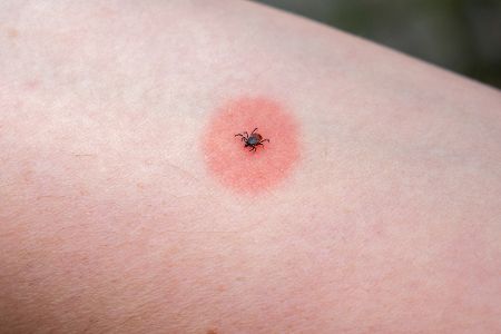 Zecke sitzt auf menschlicher Haut inmitten einer rot angelaufenen Stelle