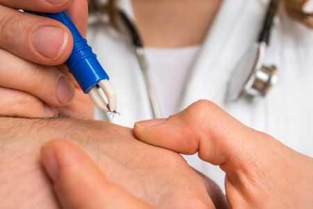 Arzt entfernt Zecke mit Zeckenzange