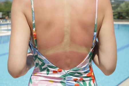 Chlor und Sonnenbrand