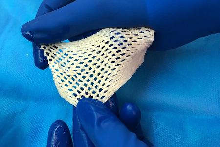 Wichtige Alternative für Hautttansplantationen: Fischhaut.