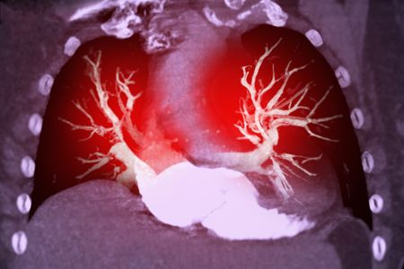 Digitales Bild einer Lungenembolie