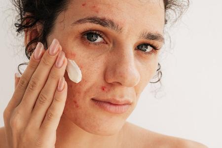 Trendwirkstoff Azelainsäure: Was kann er wirklich?