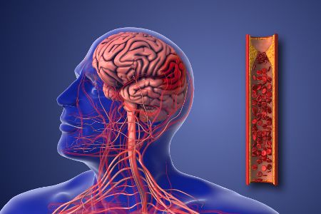 Digitales Bild eines Gehirns mit Schlaganfall, daneben verengtes Gefäß