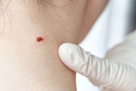 Arzt untersucht Muttermal auf Krebsbildung