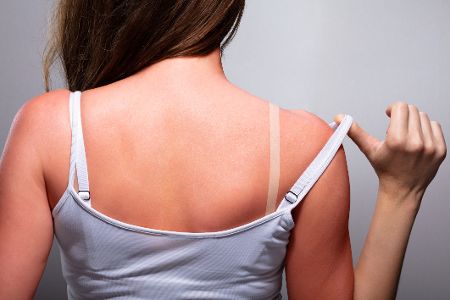 Frau zeigt Bikinistreifen und Sonnenbrand auf ihrem Rücken