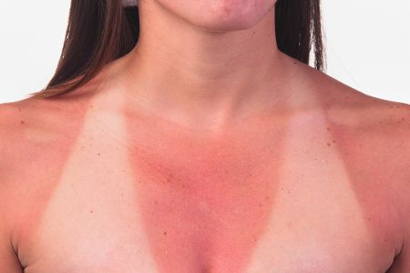 Frau mit Sonnenbrand und Bikinistreifen auf der Brust