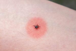 Zecken im Sommer: Was nach einem Stich wirklich wichtig ist