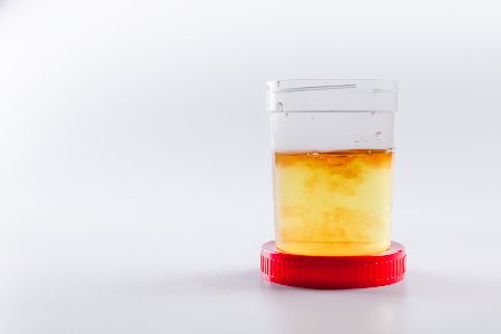 Urinprobe mit Blut